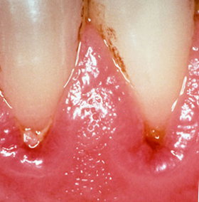 Receding gums. Image credit: AJC1 @ Flickr